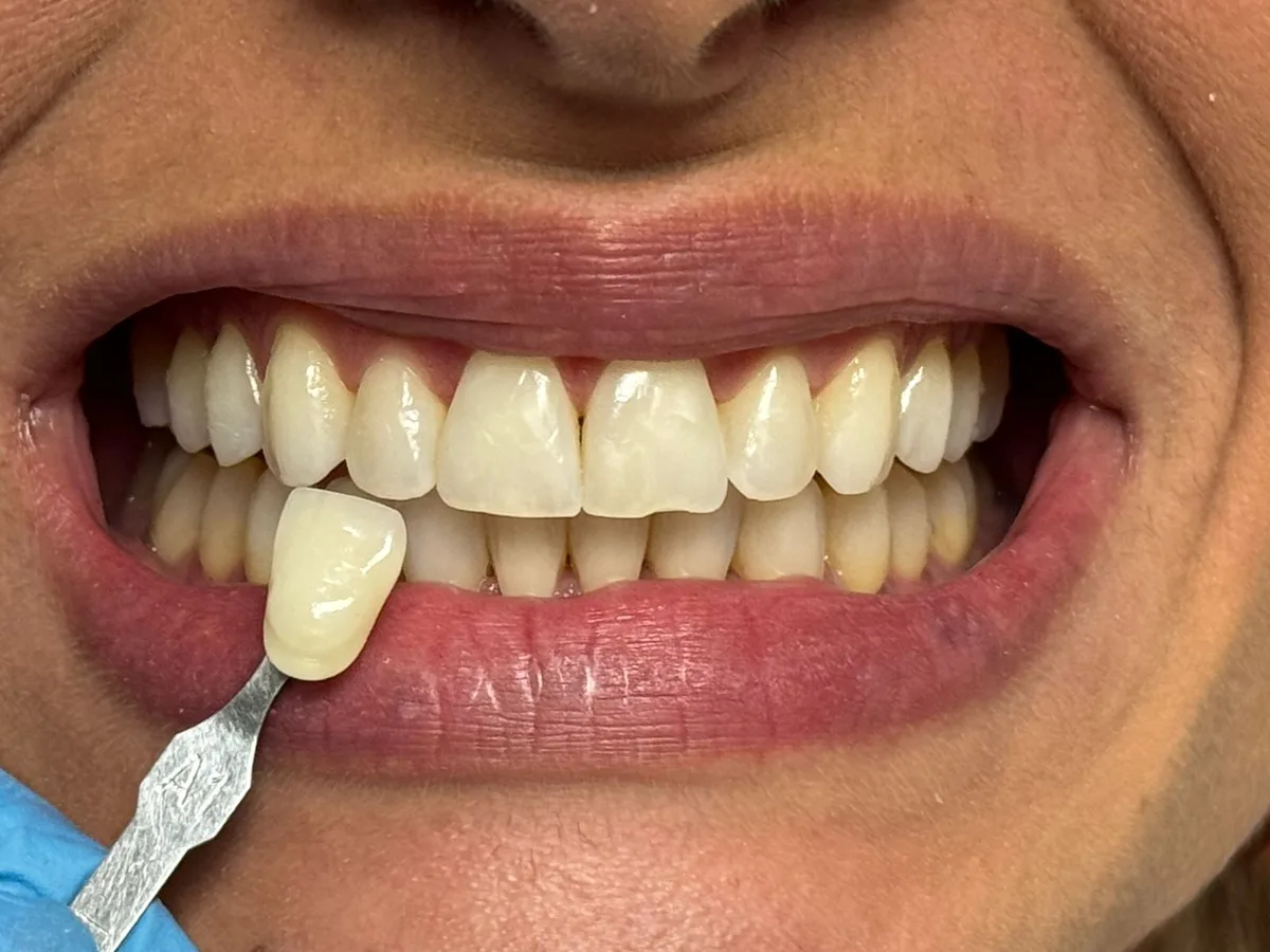 Sorriso antes do clareamento, comparado à escala de cor