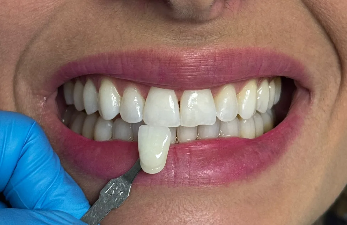 Mesmo sorriso após o clareamento, comparado à escala de cor