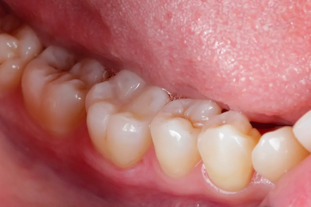 Restauração em resina composta concluída em dente posterior